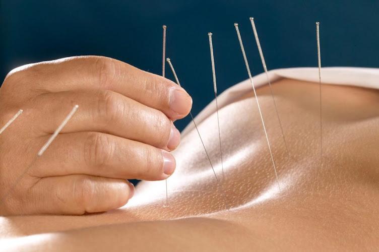 Elk Grove Acupuncture clinic