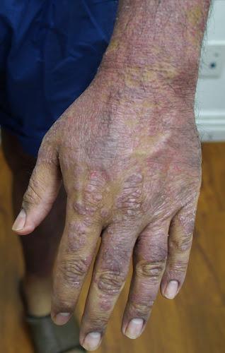 OC Psoriasis Clinic clinic