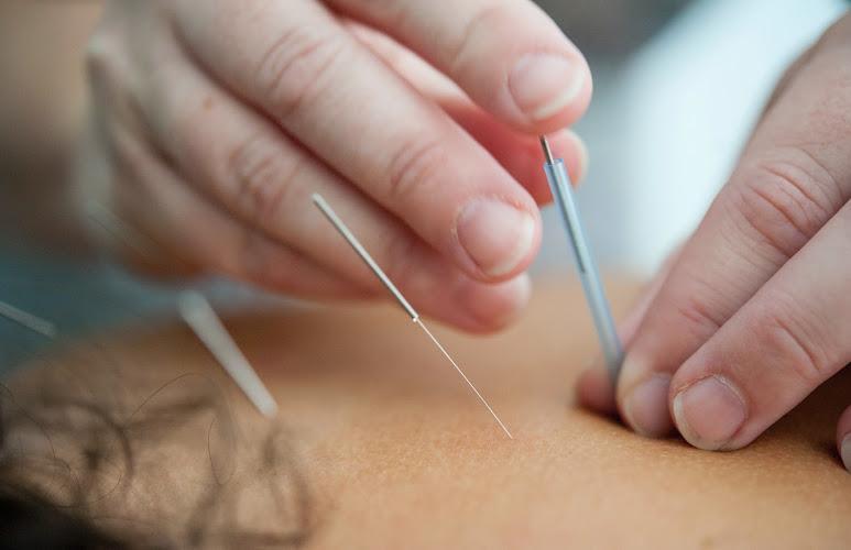 Acupuncture for Wellbeing clinic