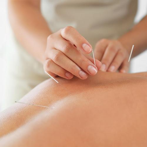 Acupuncture at the Market Place clinic