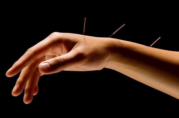 AAHOM Acupuncture: Dr. Li Jie Chu McGimsey clinic