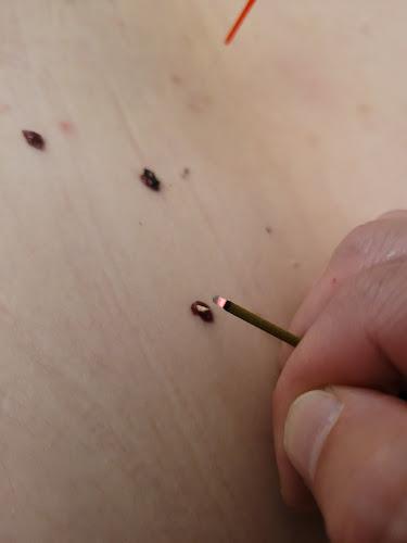 30 Minutes of Everything Japanese Acupuncture clinic